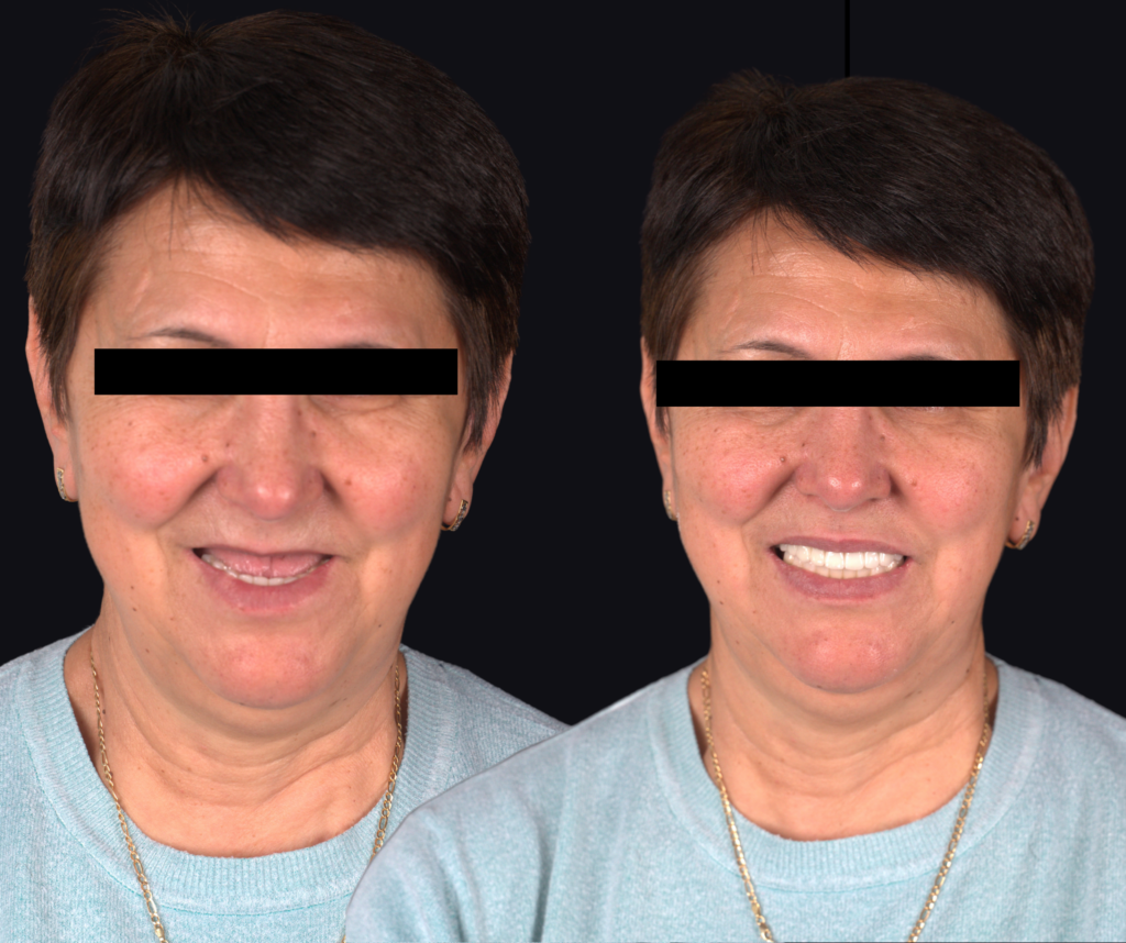 lucrare protetica pe implanturi