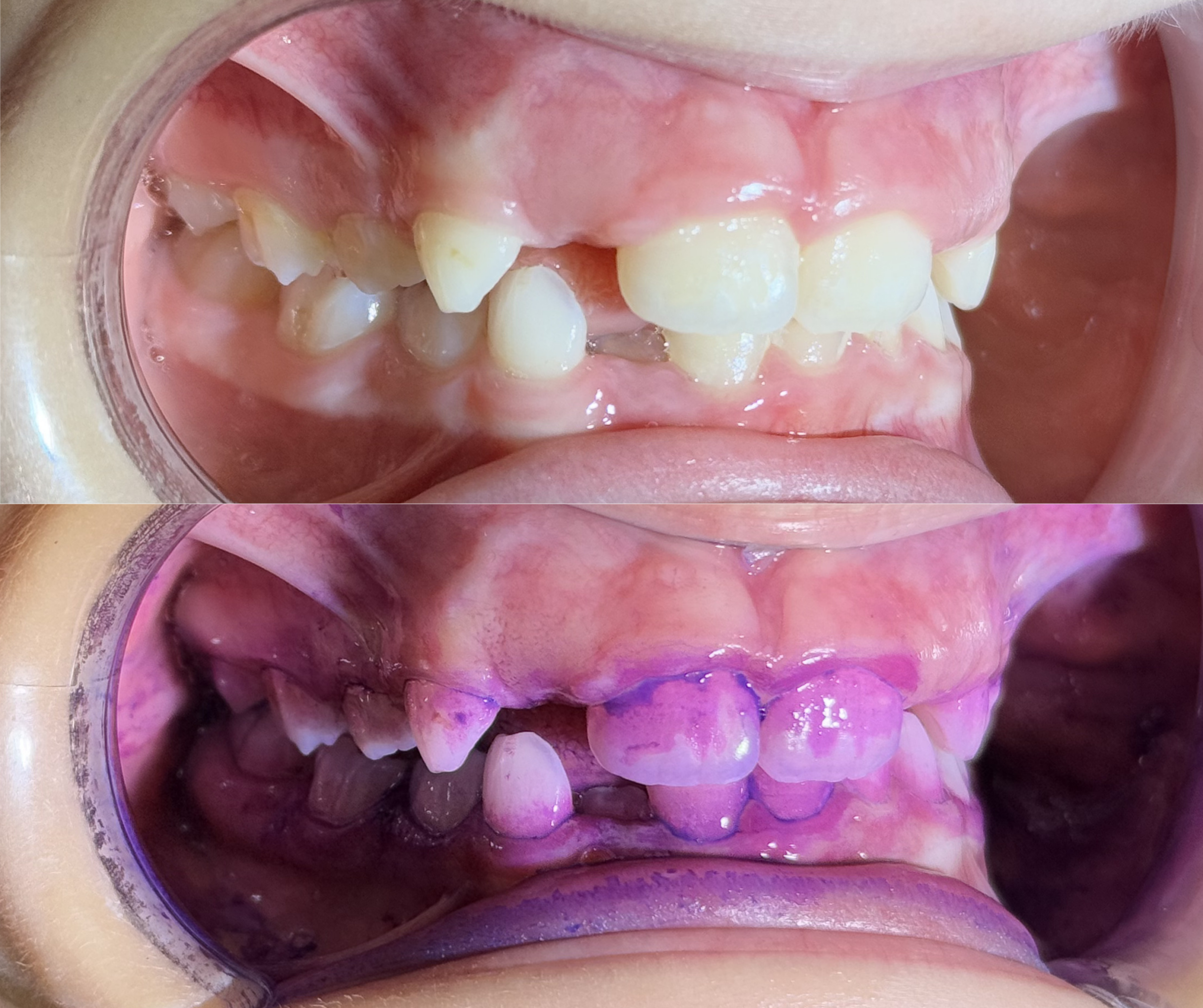 pedodontie igeinizare GBT EMS