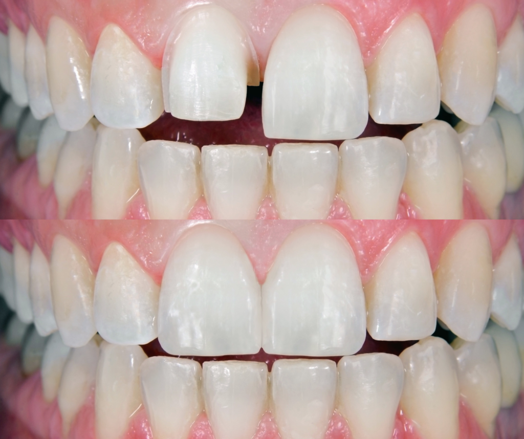 coroana dentara, fatete