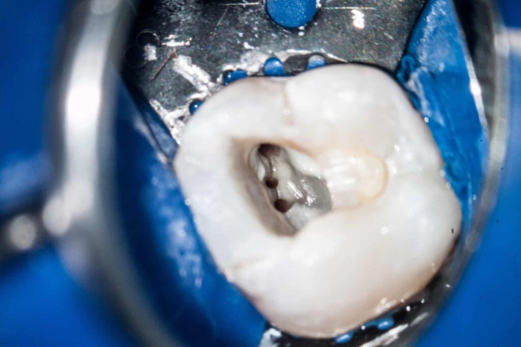 Canale radiculare văzute la microscopul dentar în timpul tratamentului endodontic