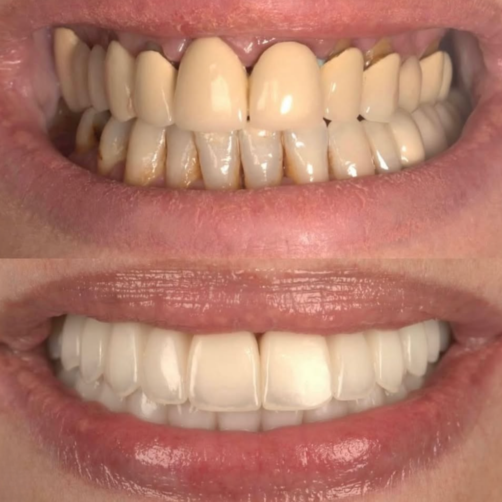 fast implant dentar coroane zirconiu