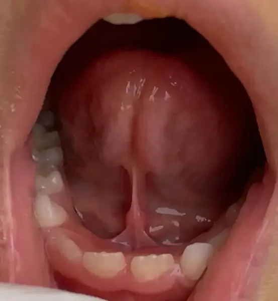 Anchiloglosie (fren lingual scurt) la un copil, pacient Twin Dent